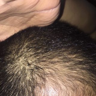 Set thuốc mọc tóc râu quai nón Minoxidil 5 nhập Mỹ - 6 chai