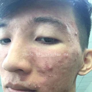 THẢO DƯỢC THIÊN NHIÊN TÁI TẠO DA HOA MỘC LAN