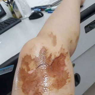 mỡ trăn trị bỏng