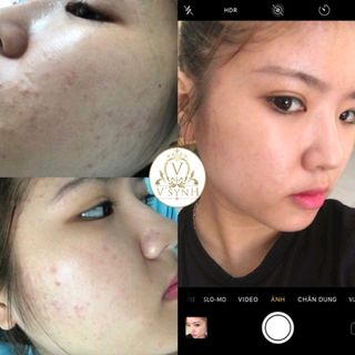 KEM FACE ĐẶC TRỊ MỤN VY BARBIE