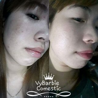 KEM FACE ĐẶC TRỊ MỤN VY BARBIE