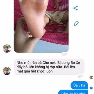 mỡ trăn trị bỏng