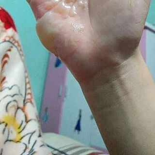 mỡ trăn trị bỏng