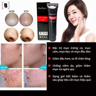 Gel trị mụn Florium 5C