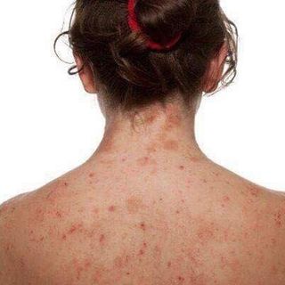 TRỊ MỤN LƯNG
