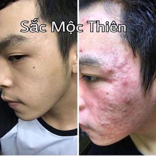 tái tạo da Sắc mộc thiên