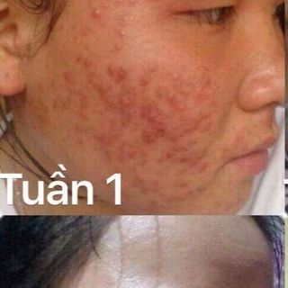 Trị Mụn Mẫu Đơn