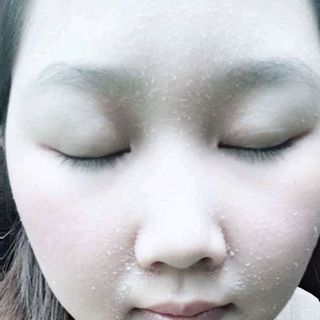 Trị Mụn Mẫu Đơn