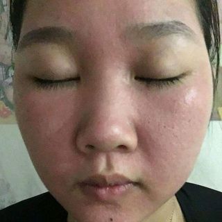 Trị Mụn Mẫu Đơn