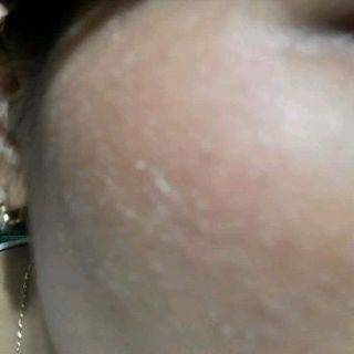 Trị Nám Mẫu Đơn