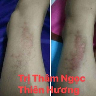 Trị thâm NGỌC THIÊN HƯƠNG