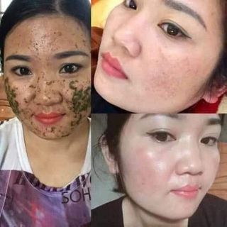 sắc mộc lam trị nám