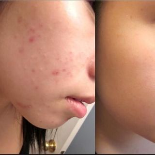 Kem nghệ Trị mụn làm mờ vết thâm Q care Thái Lan