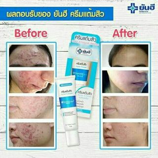 Kem Trị Mụn Yanhee Acne Cream