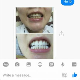 Sản Phẩm Trắng Răng Beauty Smile