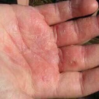 Kem trị vảy nến Dermovate