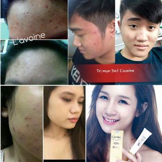 Kem trị mụn thảo dược Natural Acne Cream 3in1