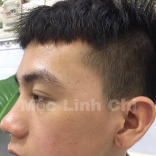 Mộc linh chi chuyên trị mụn- nám- tàn nhang