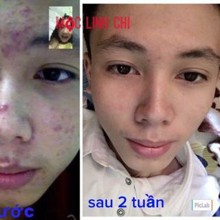 thảo dược chuyên trị mụn nám tàn nhang giá sỉ