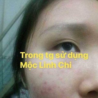 mộc linh chi trị mụn nám tàn nhang