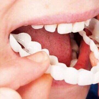 Niềng răng Snapon smile