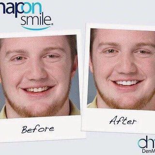 Niềng răng Snapon smile