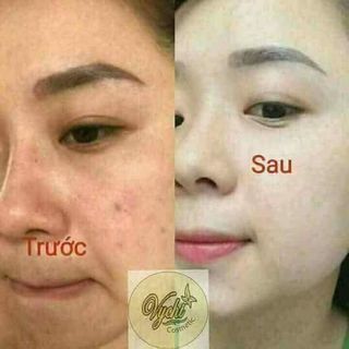 mặt nạ vychi