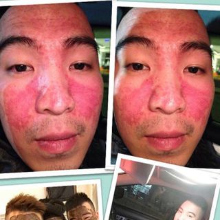 Mặt nạ trị mụn thuốc bắc an an