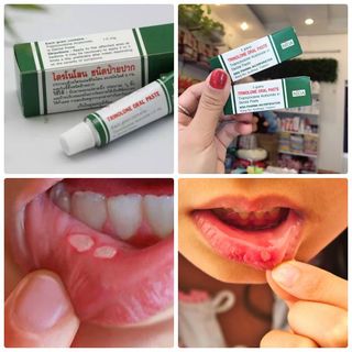 Kem Trị Lở Miệng Nhiệt Miệng Của Thái Lan Trinolone Oral Paste