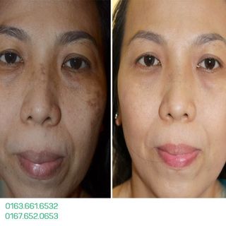 Vua trị nám Nhật Bản