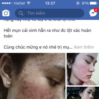 Bộ trị mụn Đông Y MAGIC full