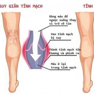Kem điều trị giãn tĩnh mạch Varikosette 75ml - Nga