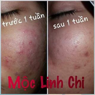 mỹ phẩm chuyên trị mụn nám tàn nhang giá sỉ