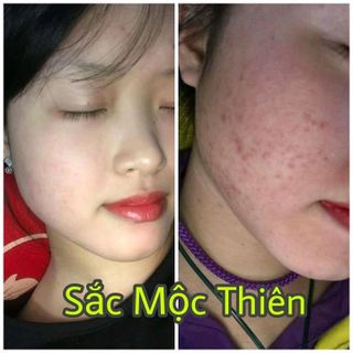 tái tạo da Sắc mộc thiên