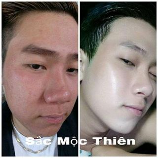 tái tạo da Sắc mộc thiên