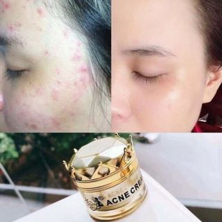 Trị mụn đông y