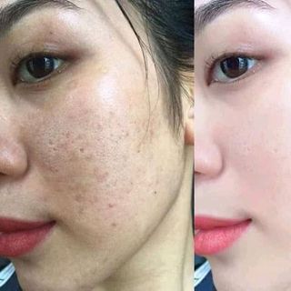 Cỏ Trị Nám Sắc mộc Lam