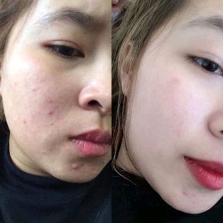 Cỏ Trị Nám Sắc mộc Lam