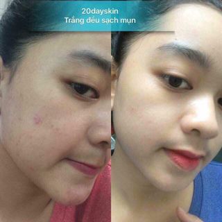 20dayskin