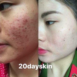 20dayskin