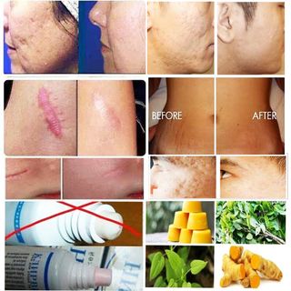 Kem Trị Sẹo Và Rạn Da Đa Năng Klirvin