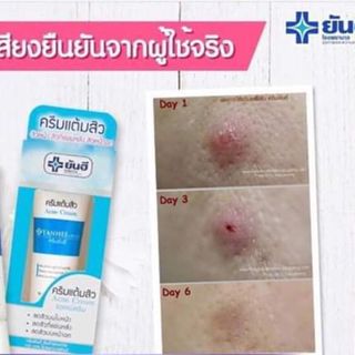 Kem Trị Mụn - YANHEE ACNE CREAM - 5gram