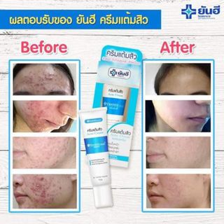 Kem Trị Mụn - YANHEE ACNE CREAM - 5gram