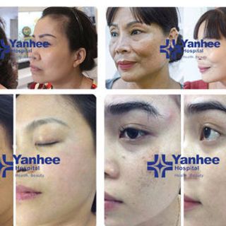 Kem trị Nám - Tàn Nhang - Đồi Mồi - YANHEE CREAM LORG FA - 20gram