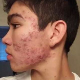 Kem trị mụn và kiềm dầu Hispa Pimple Cream