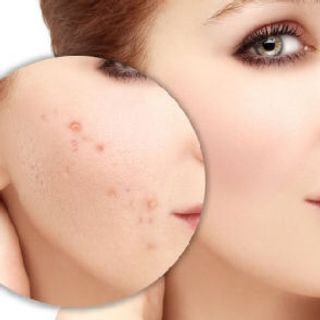 Kem dưỡng da giảm thâm mờ sẹo - VITARA E CREAM - 25gram