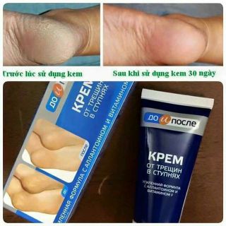 ​Kem Trị Nứt Gót Chân Hiệu Quả Kpem Nga