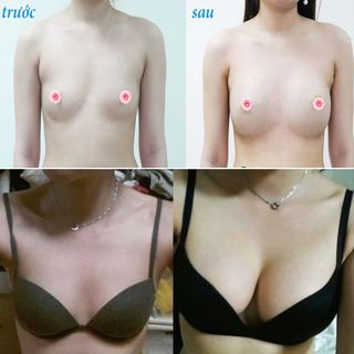Kem Nở Ngực Upsize