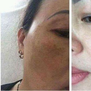 lem trị nám