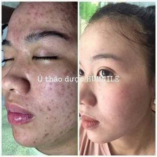Mặt nạ thảo dược Humile